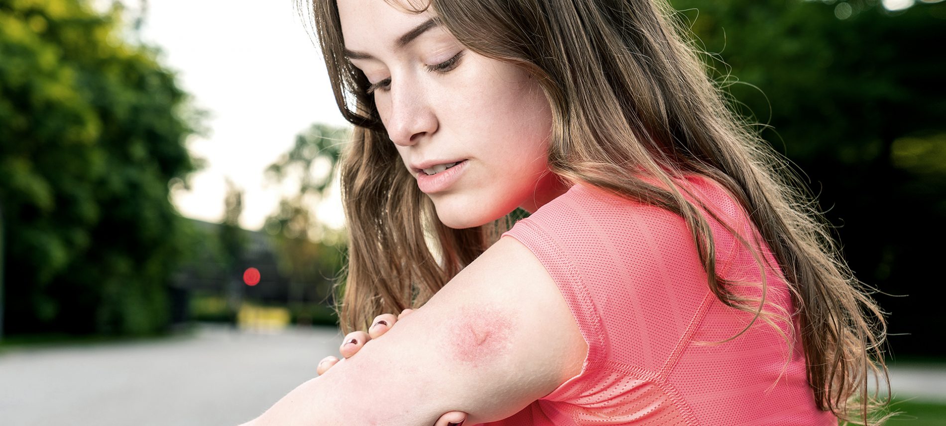 Viactiv Krankenkasse Insektenstich | VIACTIV Krankenkasse