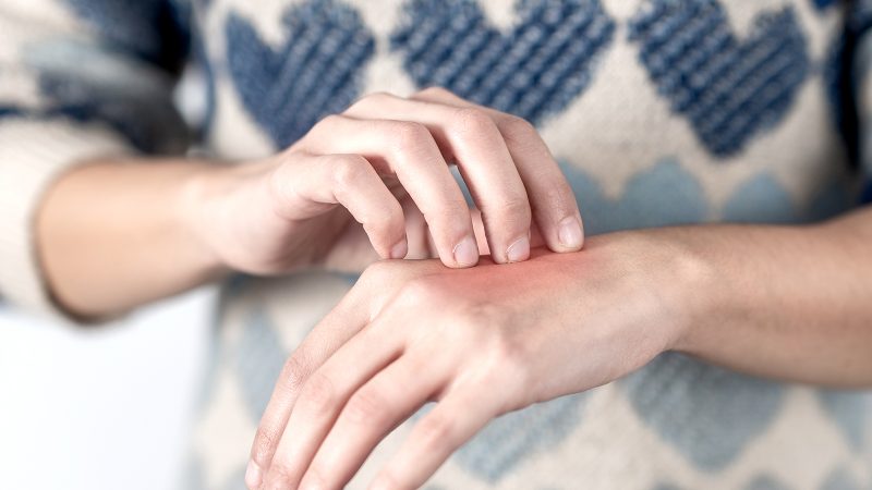 Viactiv Krankenkasse Juckreiz | VIACTIV Krankenkasse
