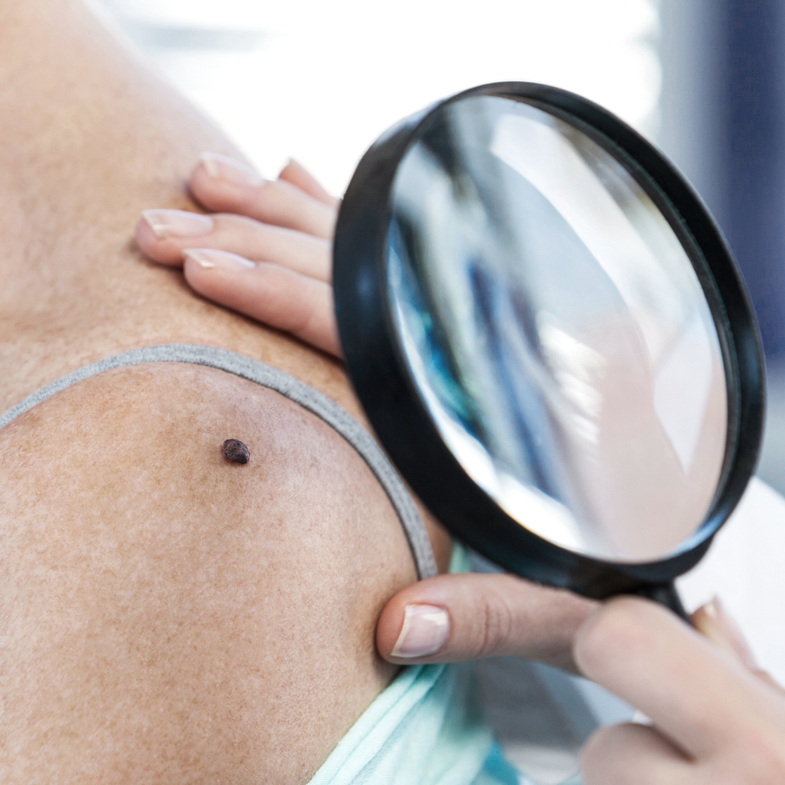 Viactiv Krankenkasse-Muttermale | VIACTIV Krankenkasse