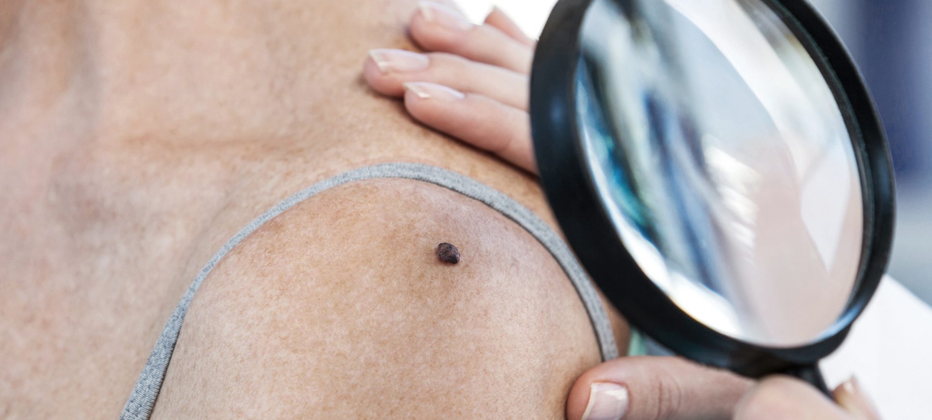 Viactiv Krankenkasse-Muttermale | VIACTIV Krankenkasse